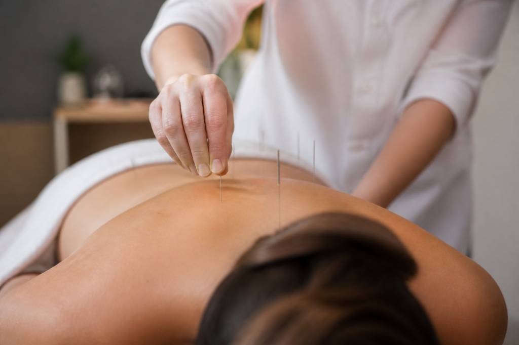 Acupuncture etude : quelle formation pour exercer ce métier